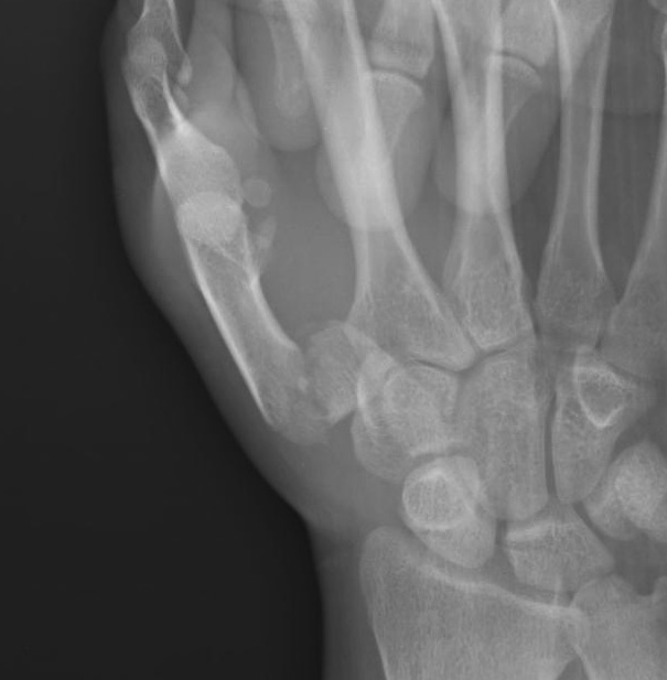 Bennetts Fracture